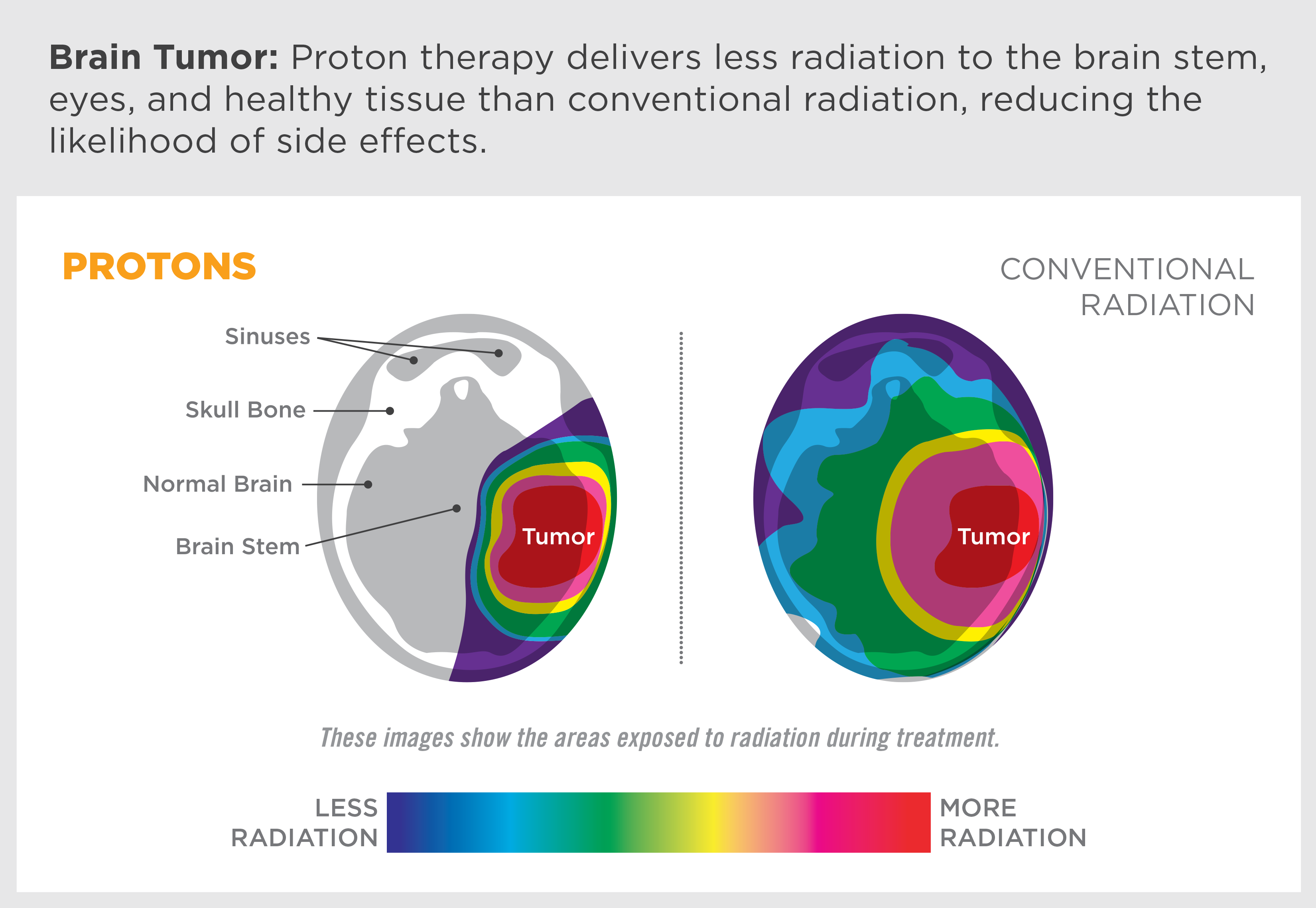 brain-tumor-advanced-treatment – Time Scavengers